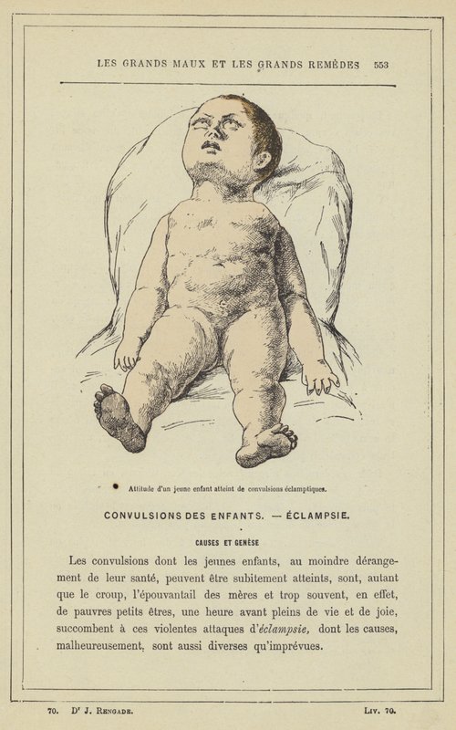 Pienen lapsen asenne, jolla on eklampsia kouristuksia (väri litho) tekijältä French School