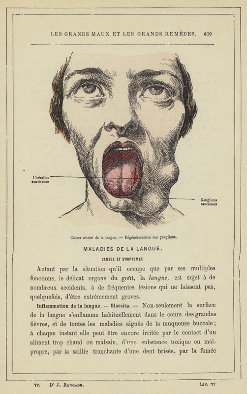 Kielen haavasyöpä, imusolmukkeiden rappeuma (väri litho) tekijältä French School