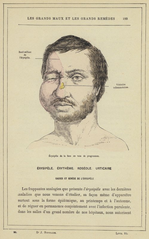 Erisipela de la cara en curs (color lito)finís tekijältä French School
