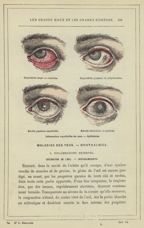 Pinnalliset silmätulehdukset, Oftalmia (väri litho) tekijältä French School