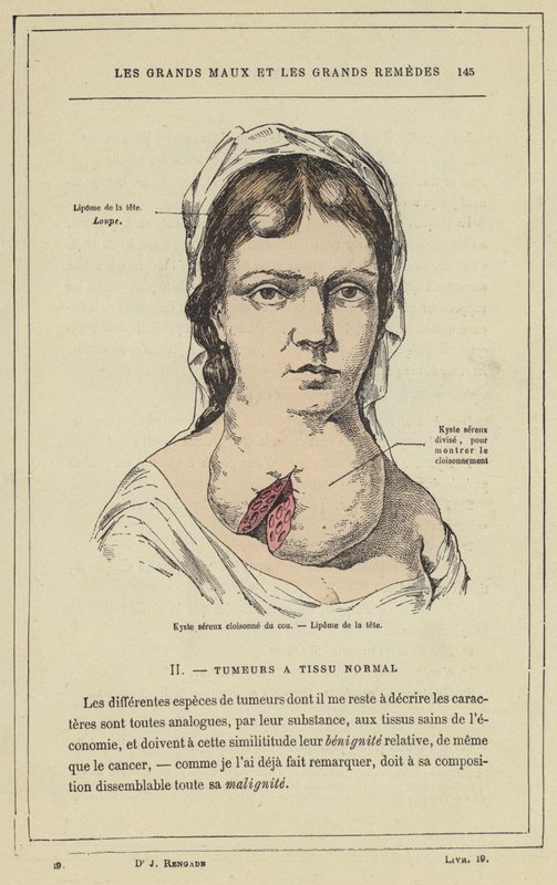 Cloisonnen seroosikysta kaulassa, pään lipoma (väri litho) tekijältä French School