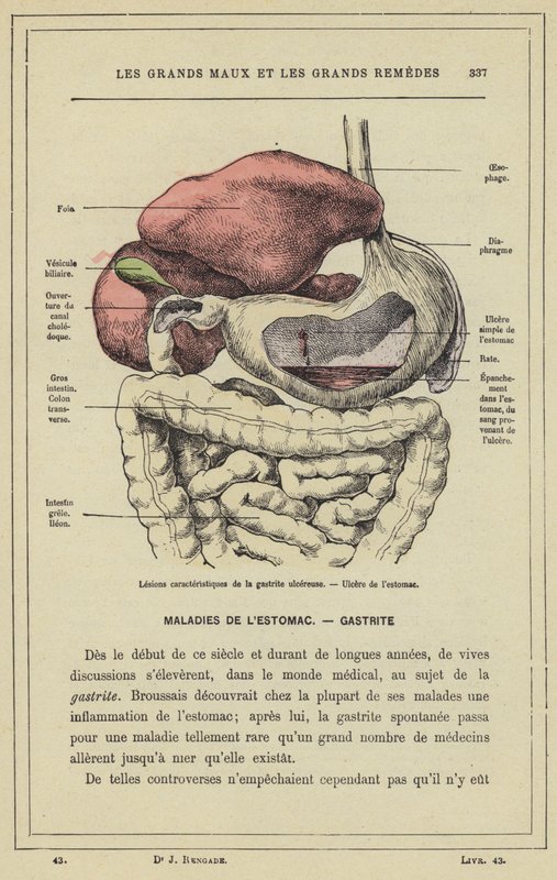 Haavaisen gastriitin tyypilliset leesiot, mahahaava (väri litho) tekijältä French School