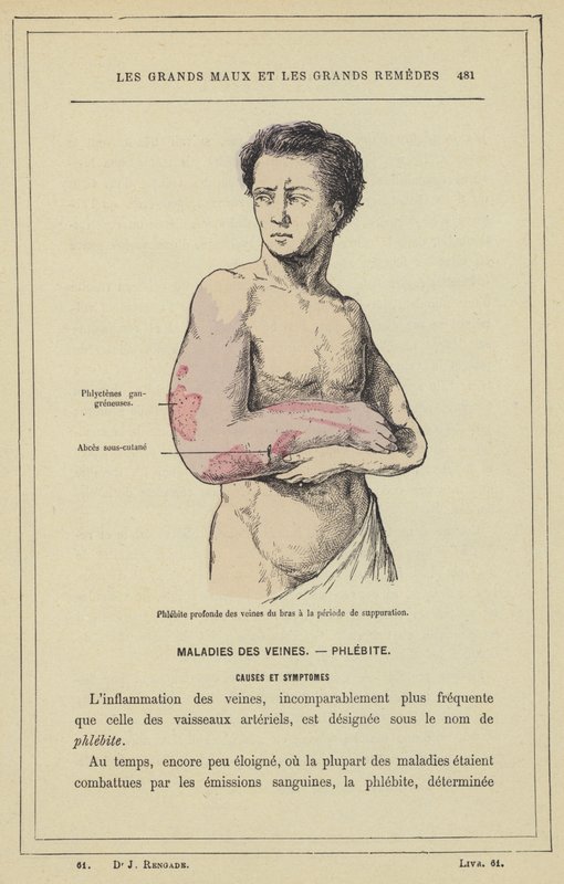 Käsivarren suonten syvä flebiitti märkimisen aikana (väri litho) tekijältä French School