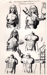 Rintasyöpäleikkaus, Johannes Schultesin (1595-1645) teoksesta "Armamentarium Chirurgicum", julkaistu Amsterdamissa, 1672