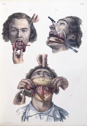 Alaleuan leikkaus, kuvalaatta Jean-Baptiste Marc Bourgeryn (1797-1849) teoksesta "Traité complet de l’anatomie de l’homme", 1866-67