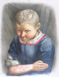 Favus, Daniel Cornelius Danielssenin (1815-94) kirjasta 1892
