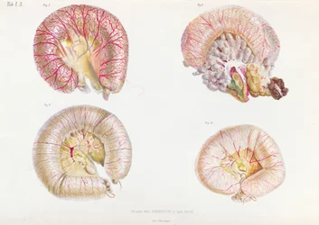 Koleratartunnan saaneiden suoliston ulkopinta, Anatomie Pathologique du Cholera Morbus, Nikolai Ivanovich Pirogov (1810-81), julkaistu Pietarissa, 1849