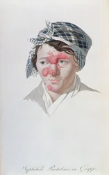 Syfiliset klusterin märkärakkulat, paroni Jean Louis Alibertin (1768-1837) kirjasta 1838