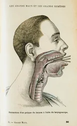 Laryngoskoopin käyttäminen polyypin poistamiseen kurkusta, c1890