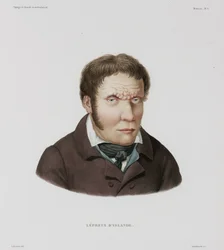 Sairaudet, Lepra