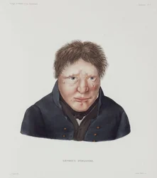 Sairaudet, Lepra Mies spitaalinen, Islanti, 1800-luvun alku